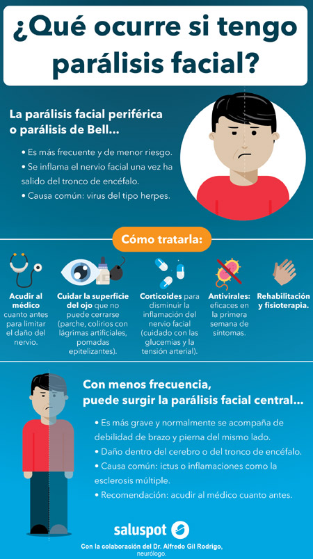 ¿Qué ocurre si tengo parálisis facial?